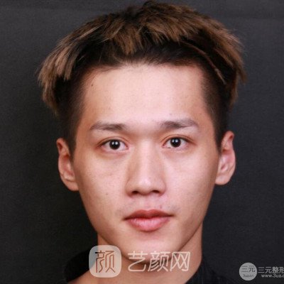 重慶軍美胡金香鼻部手術六個月了，分享恢復果~